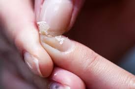 brittle nails 6 common causes what