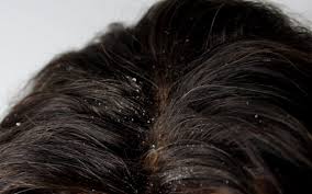 connection between dandruff and food
