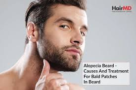 alopecia beard causes treatment for