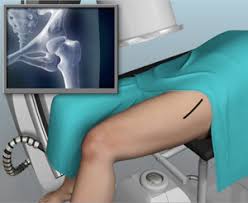 anterior hip replacement with x ray