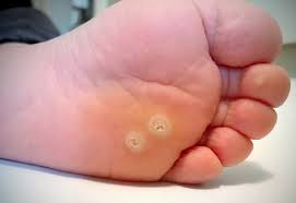 don t let plantar warts spoil your fun