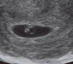 Kann das echt sein das in der 5 ssw noch nichts zu sehen ist beim ultraschall. Ultraschallbilder Einer Schwangerschaft