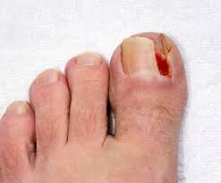 ingrown toenails treatment in pasadena