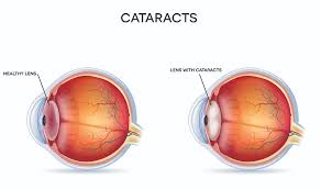 cataract surgery calgary edmonton ab