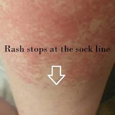 the disney rash description