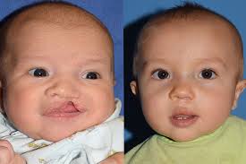 clefts of the lip and palate