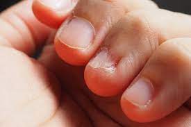 nail disorders in children know the