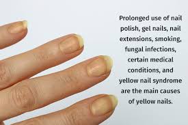 8 home remes for yellow nails