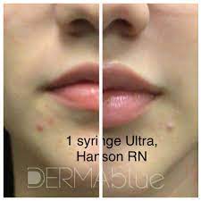 a closer look at lip fillers before and