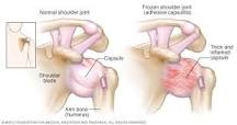Image result for icd 10 code for frozen shoulder unspecified