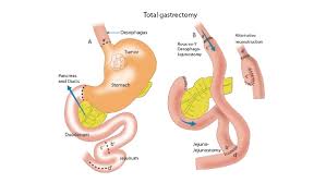 total gastrectomy