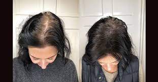 scalp micropigmentation benefits side