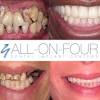 Free dental implants for low income uk. 1