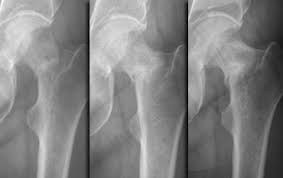 the radiology istant stress fractures