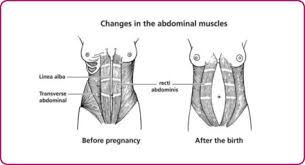 divarication of abdominal muscles