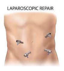 about laparoscopic hernia surgery