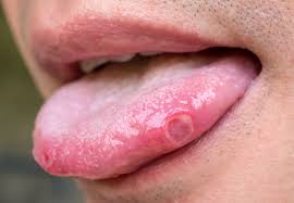 You might notice a tingling or burning sensation a day or two before the sores actually appear. 7 Signs Your Painful Mouth Sore Could Be Something More Serious Health Essentials From Cleveland Clinic