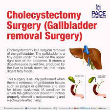 gallbladder removal surgery in