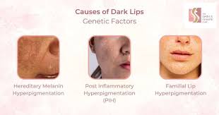 dark lips treatment by dermatologist