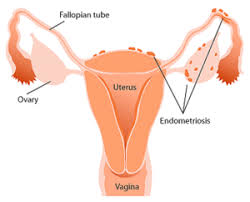 endometriosis physiopedia