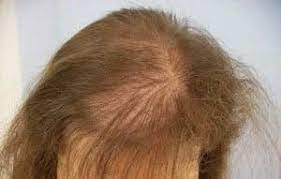 telogen effluvium hair loss after wls