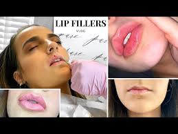 getting lip fillers for the first time