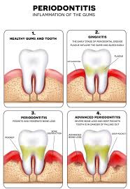 what does gum disease mean north