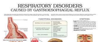 Respiratory Disorders Caused By Gastroesophageal Reflux Anejo