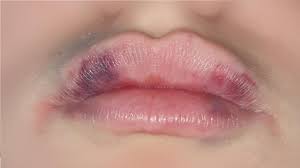 lip bruises after kissing