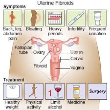 uterine fibroids what you need to know