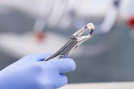 tooth extraction expectations