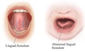 frenectomy tongue tie release