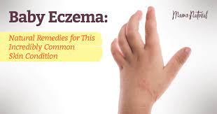 baby eczema natural remes for this