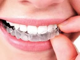 Braces Colors How To Pick The Best Braces Color For Your