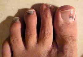 black toe nails or runners toe