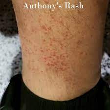 the disney rash description