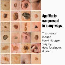 age warts seborrhoeic keratosis dr