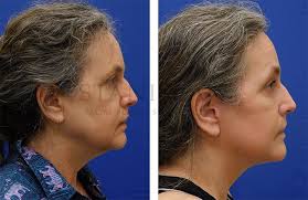 facelift expert in connecticut