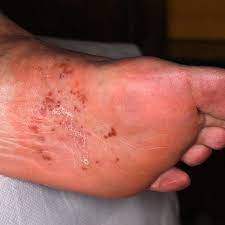 dyshidrotic eczema on the feet most