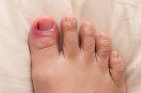 how to remove an ingrown toenail the