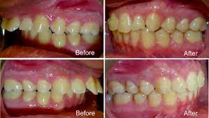 In fact, improvised treatments may even aggravate the patient's condition. What Is Overjet Symptoms Diagnosis And Orthodontic Treatment