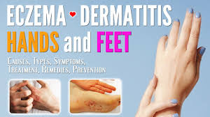 eczema on hands and feet causes
