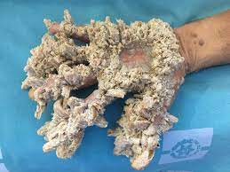 Mahmoud taluli, 44, suffers from epidermodysplasia. Gazan With Tree Man Syndrome Responds To Pioneering Surgical Treatment Goats And Soda Npr