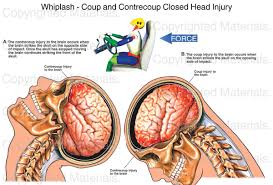 Whiplash Coup And Contrecoup Closed Head Injury Medical