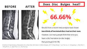 does disc bulges heal and how long does