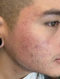 acne scar removal treatment