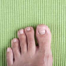 all about ingrown toenails allcare