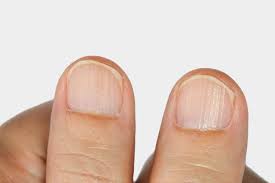 causes of ridges in fingernails