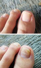 treat fungal nails laser therapy