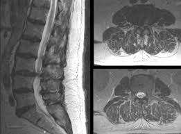 herniated disk l3